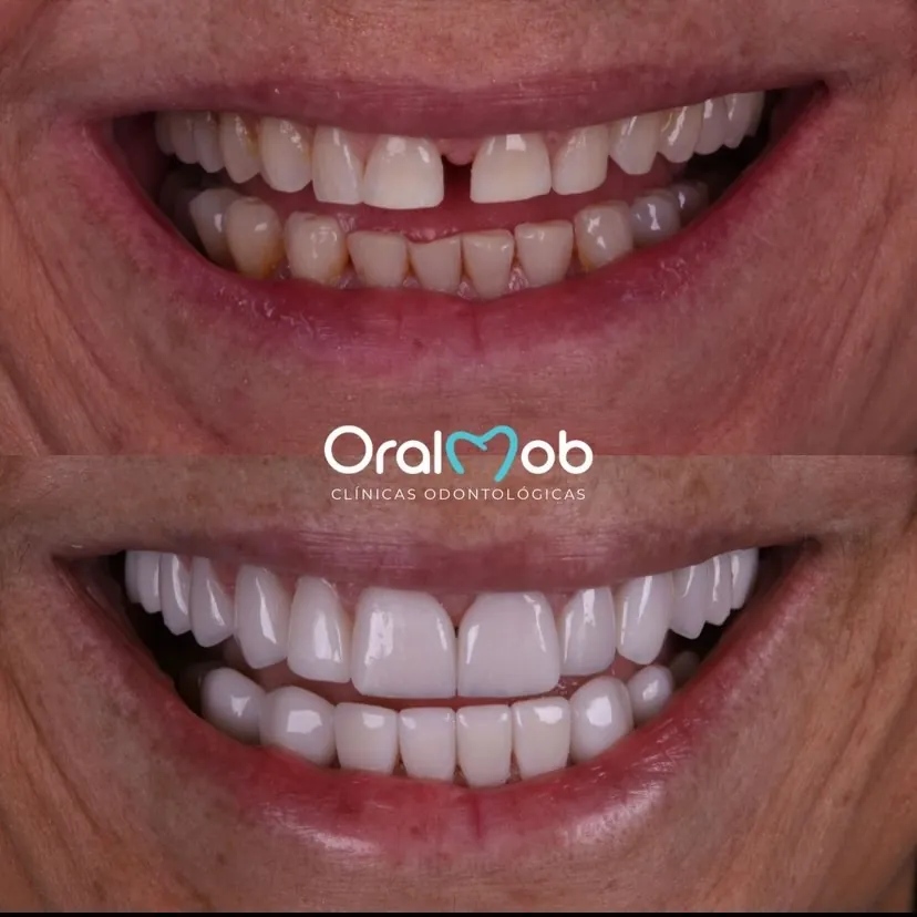 Caso real de transformação de sorriso na Oralmob — antes e depois com implantes, lentes em porcelana e coroas em zircônia